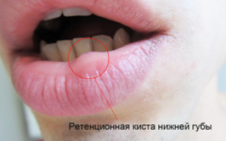 Киста на нижней губе