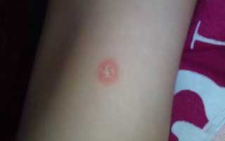 Красные пятна на коже с корочкой