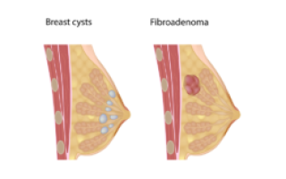 Мелкие камни в груди после гв