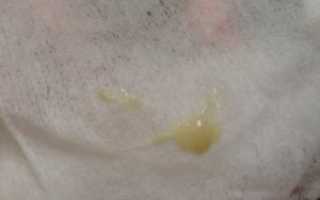 Мазок хороший, а выделения желтые обильные. Что это может означать?