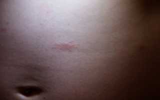 Локальные прыщи на правом боку