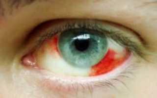 Кровавое пятно на глазе, когда снимала контактные линзы