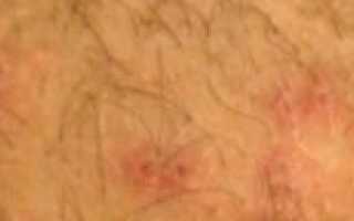 Красная шишечка, на головке полового члена (ребенку 5 лет)