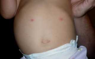 Красные пятна внизу живота у ребенка