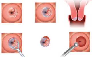 Большой сгусток крови после прижигание эрозии