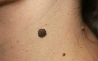 Большой невус