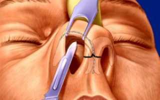 Как легче для пациента удалить шип в носу