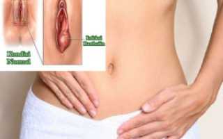 Большое уплотнение на внешней стороне большой половой губы