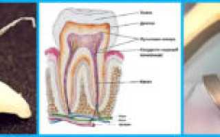 Болит зуб без нерва и воняет