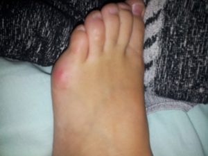 Красные мягкие шишки возле суставов пальца