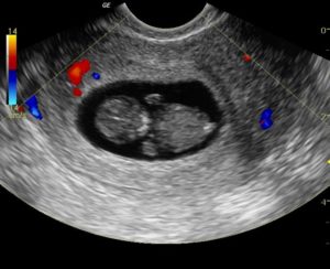 Лечение после замершей беременности