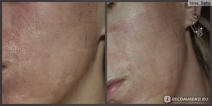 Корочки после лазерной шлифовки