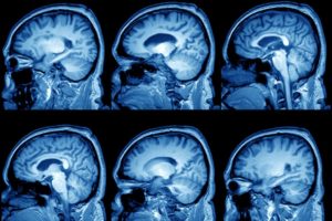 Киста головного мозга