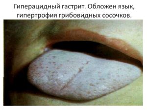 Хронический гастрит и белый налёт на языке
