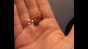 Медикаментозный аборт, плодное яйцо не вышло