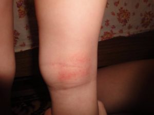 Красное шершавое пятно на бицепсе