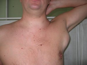 Лимфома? Потливость