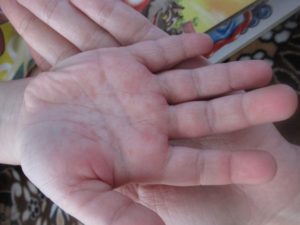 Красные высыпания на ладонях