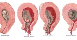 Медикаментозный аборт, плодное яйцо не вышло
