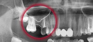 Лечение 26 зуба и гайморова пазуха