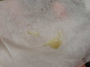 Мазок хороший, а выделения желтые обильные. Что это может означать?