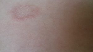 Красное пятно на коже увеличилось