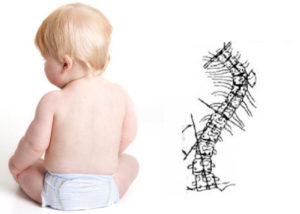 Хруст позвоночника у трехмесячного ребенка