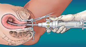 Лечение после замершей беременности