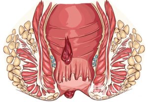 Кровь из анального отверстия после тренировок по бодибилдингу