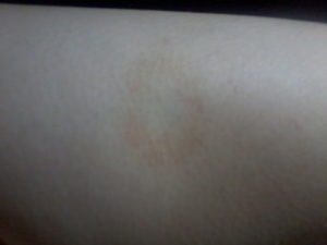 Круглое светло-голубое пятно на спине