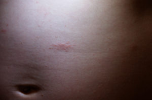 Локальные прыщи на правом боку