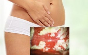 Как предотвратить молочницу после бассейна