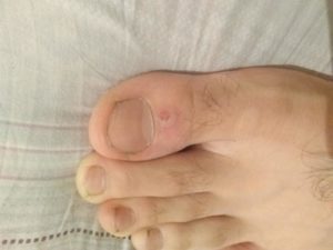 Болячка на ступне