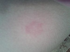 Красные пятна похожие на засовы по всему телу