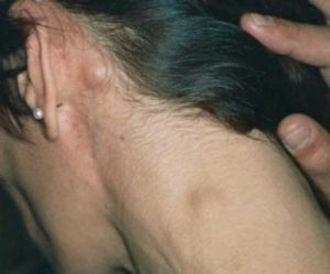 Лимфома? Потливость