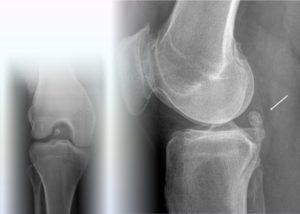 Инородное тело в колене