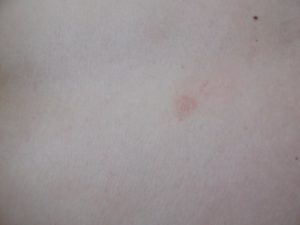 Круглое светло-голубое пятно на спине