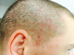 Как лечить образование в голове