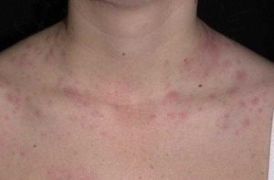 Красные пятна похожие на крапивницу