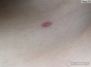 Красное пятно после удаления родинки лазером