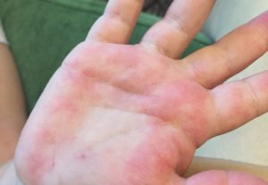 Красные ладошки, не проходящий зуд у ребенка
