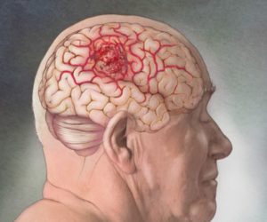 Как лечить образование в голове