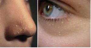 Как избавиться от милиумов на лице в домашних условиях