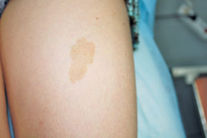 Кофейные пятна пигментация у ребенка