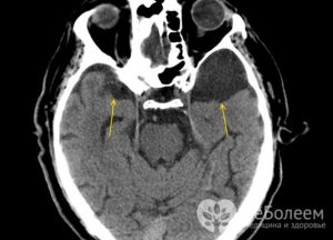 Киста головного мозга