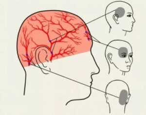 Болит голова сзади вверху (впервые)