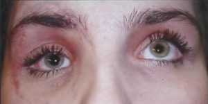 Перелом орбиты глаза
