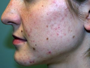 Большое количество прыщей и угрей