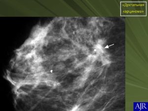 Инфильтративная дуктальная карценома