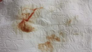 Кровь при беременности после ПА